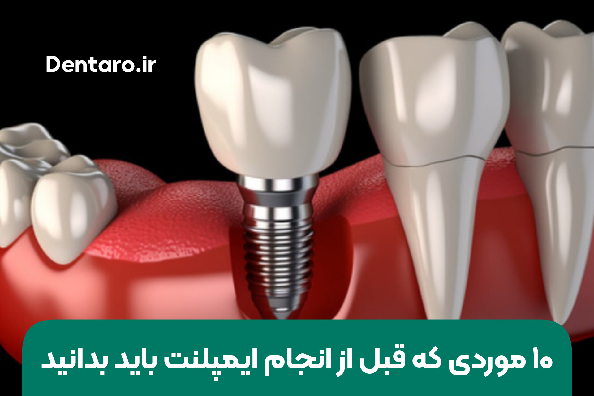 دنتارو ۱۰ موردی که قبل از انجام ایمپلنت باید بدانید