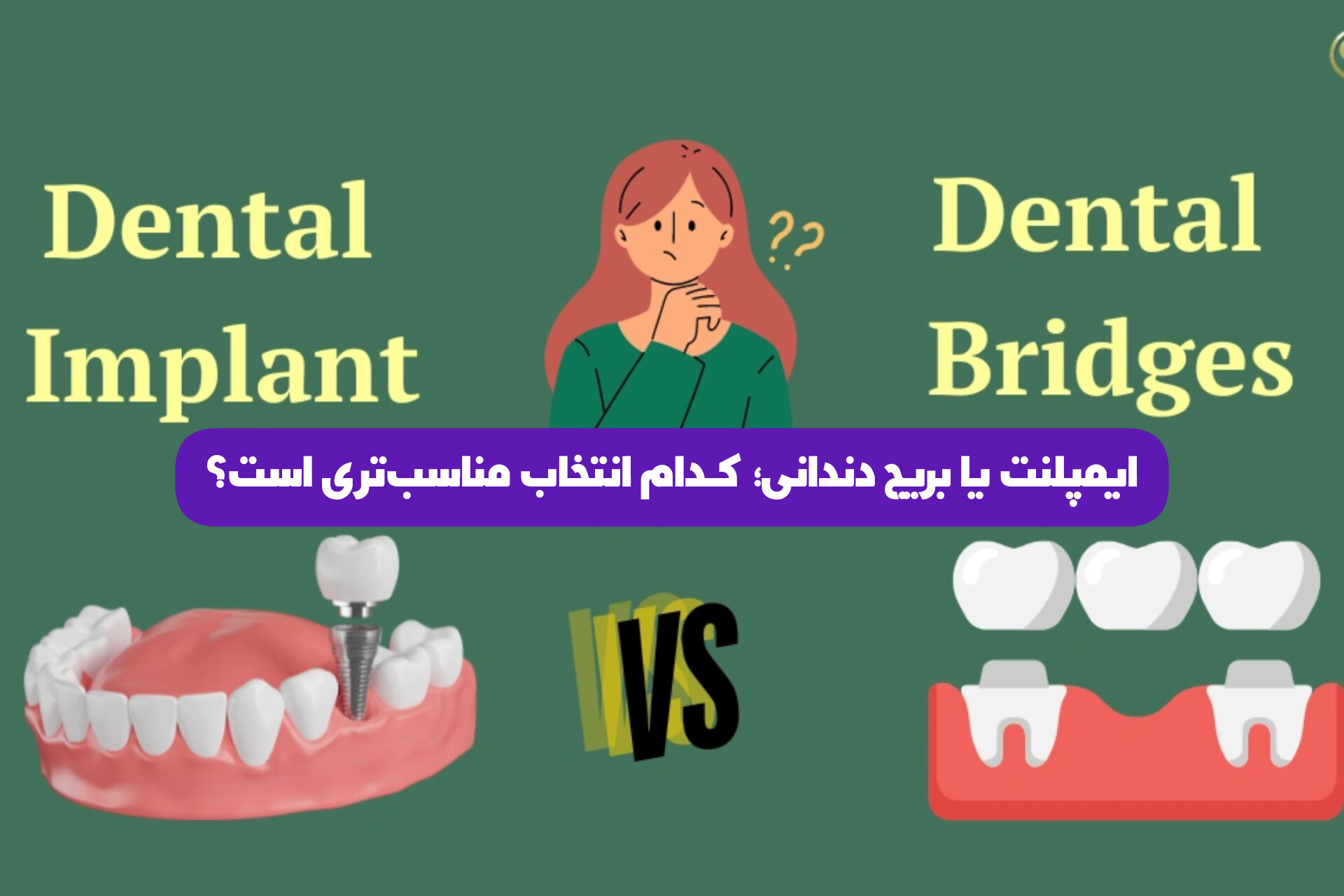 ایمپلنت یا بریج دندانی؛ کدام انتخاب مناسب‌تری است؟