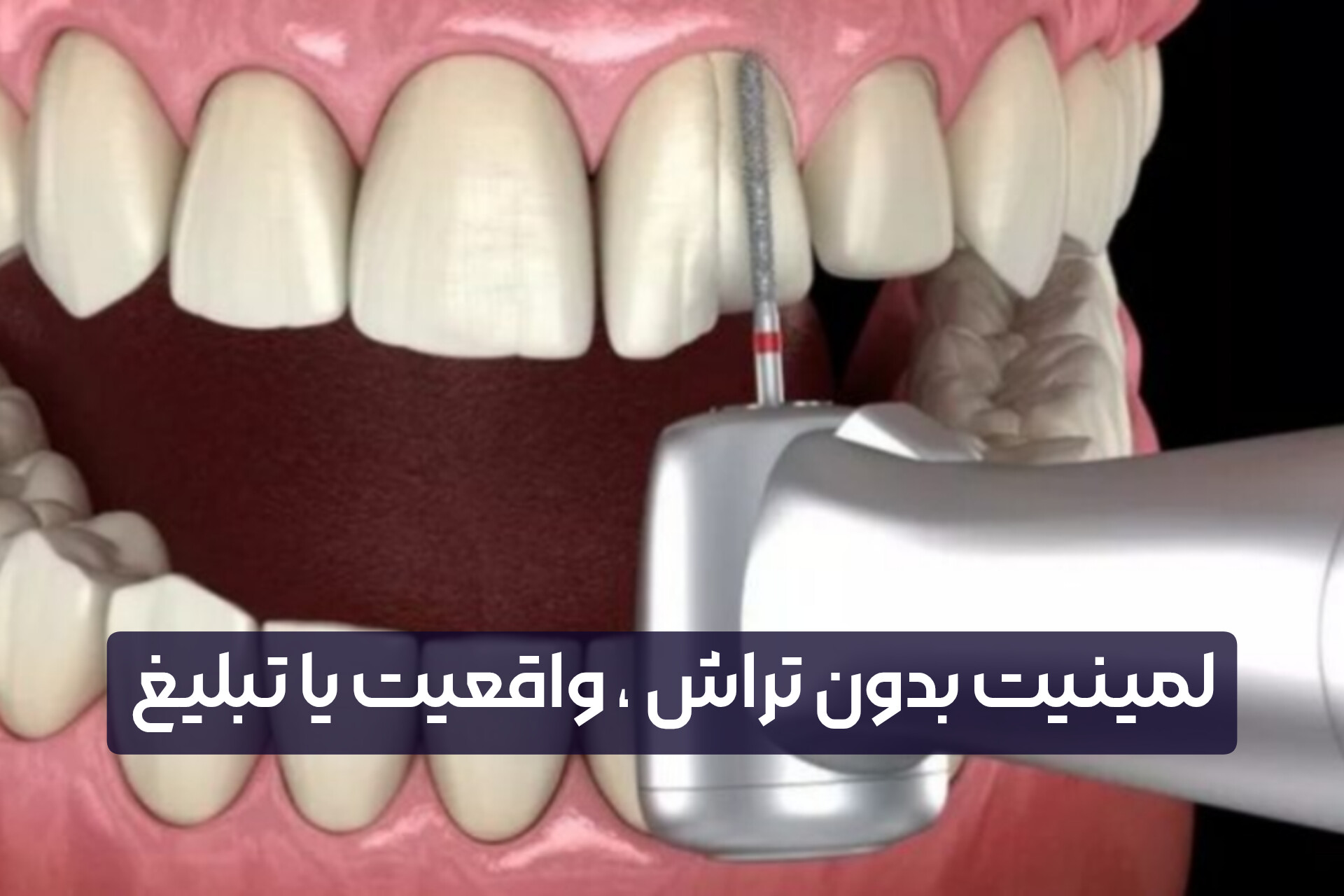 لمینیت بدون تراش ، واقعیت یا تبلیغ