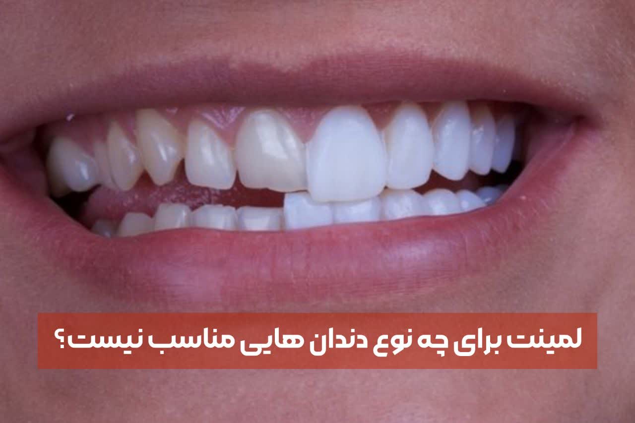 دنتارو لمینت برای چه نوع دندان‌هایی مناسب است؟