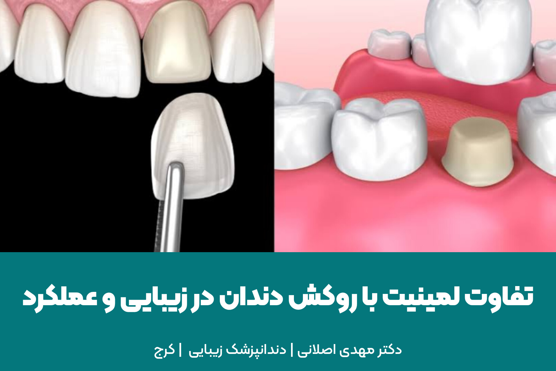 تفاوت لمینیت با روکش دندان در زیبایی و عملکرد