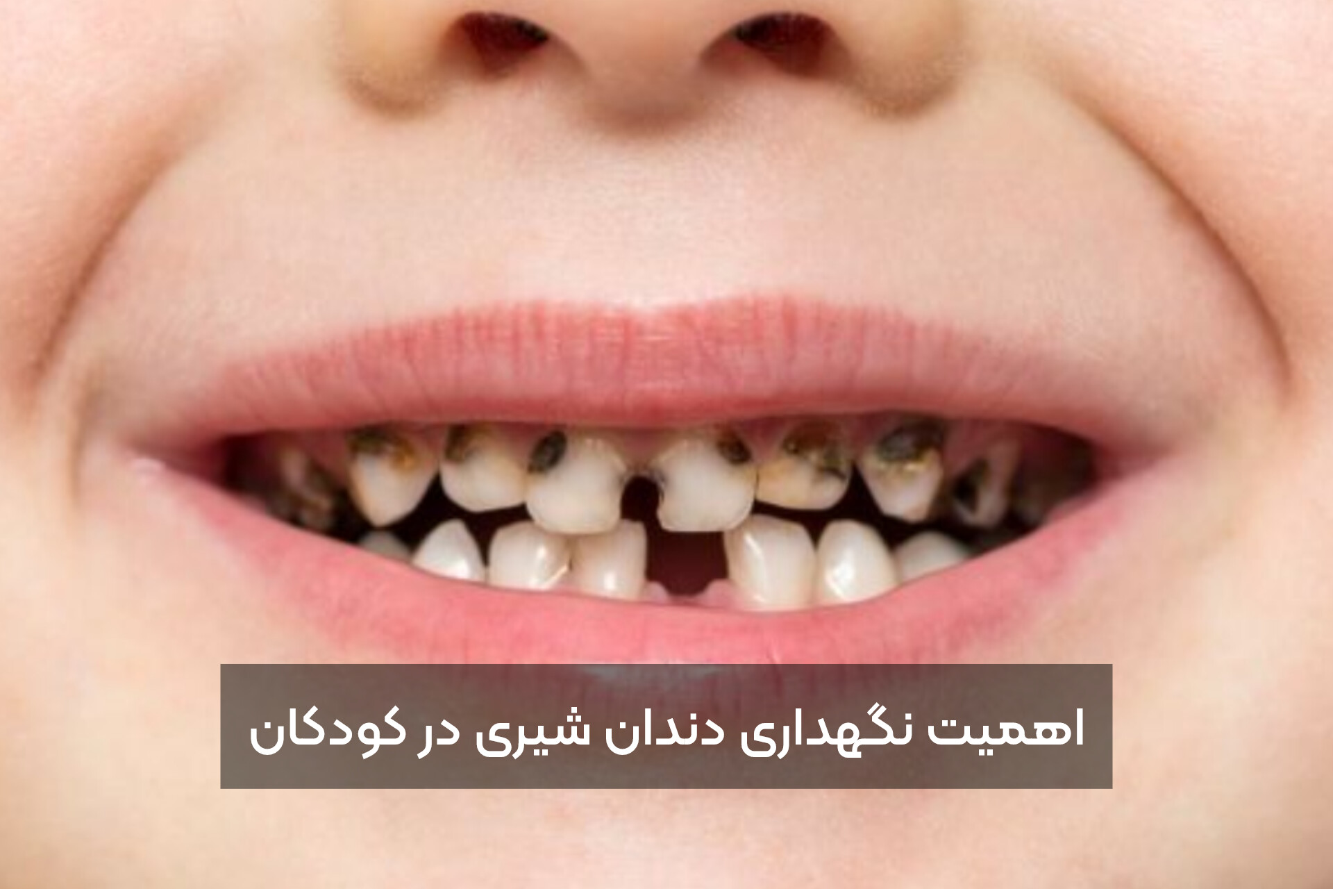 اهمیت نگهداری دندان شیری در کودکان