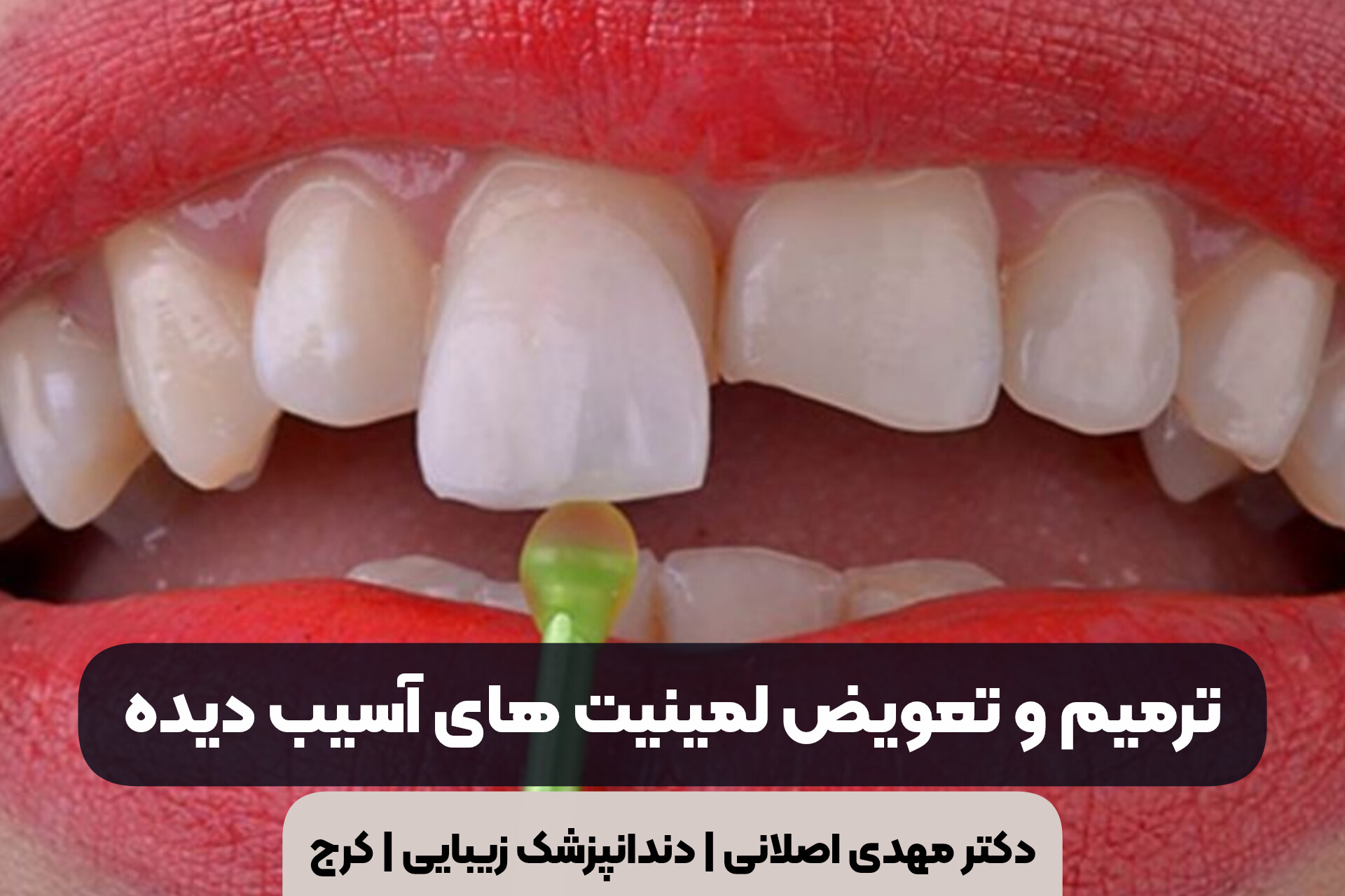 ترمیم و تعویض لمینیت های آسیب دیده