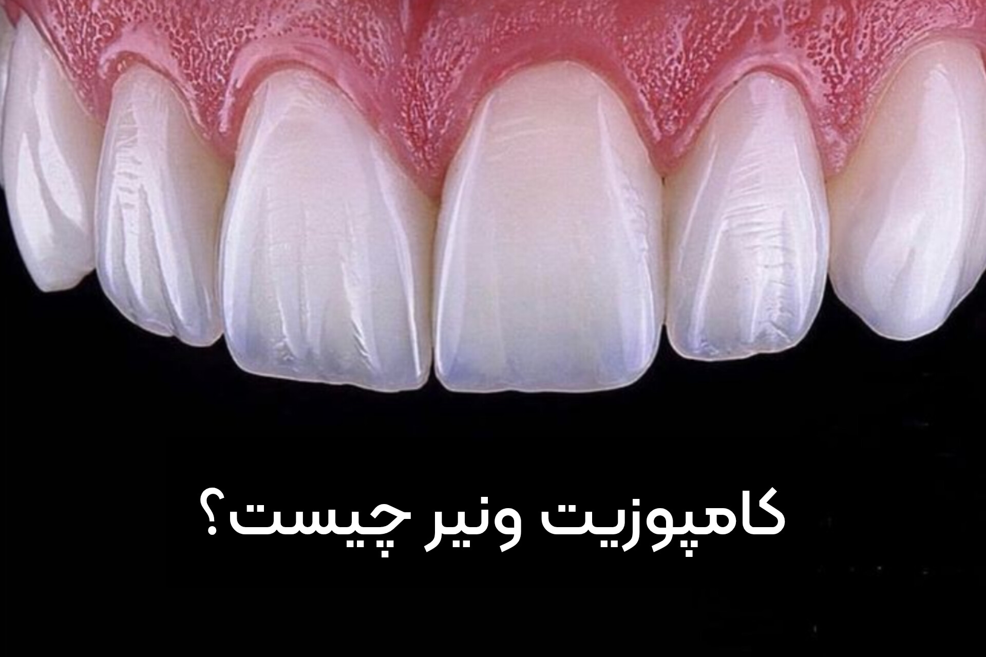 دنتارو کامپوزیت ونیر چیست