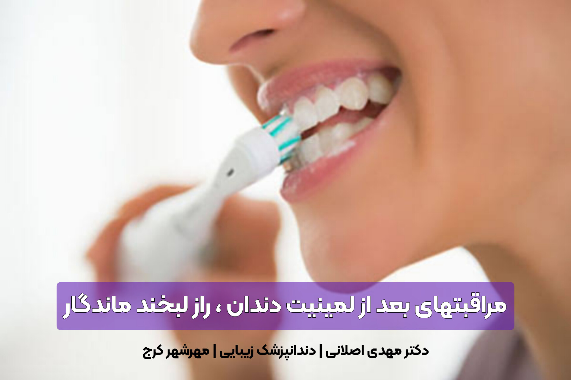 مراقبتهای بعد از لمینیت دندان ، راز لبخند ماندگار