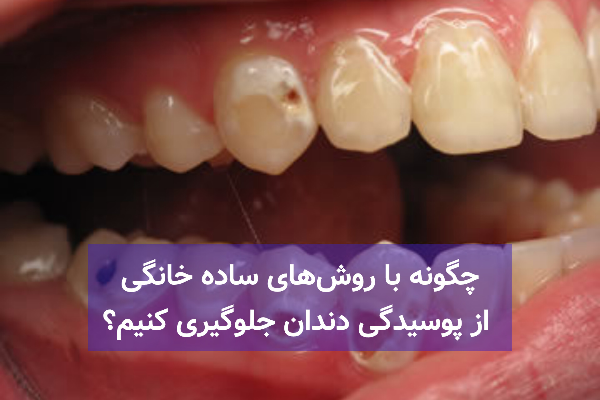 چگونه با روش‌های ساده خانگی از پوسیدگی دندان جلوگیری کنیم؟