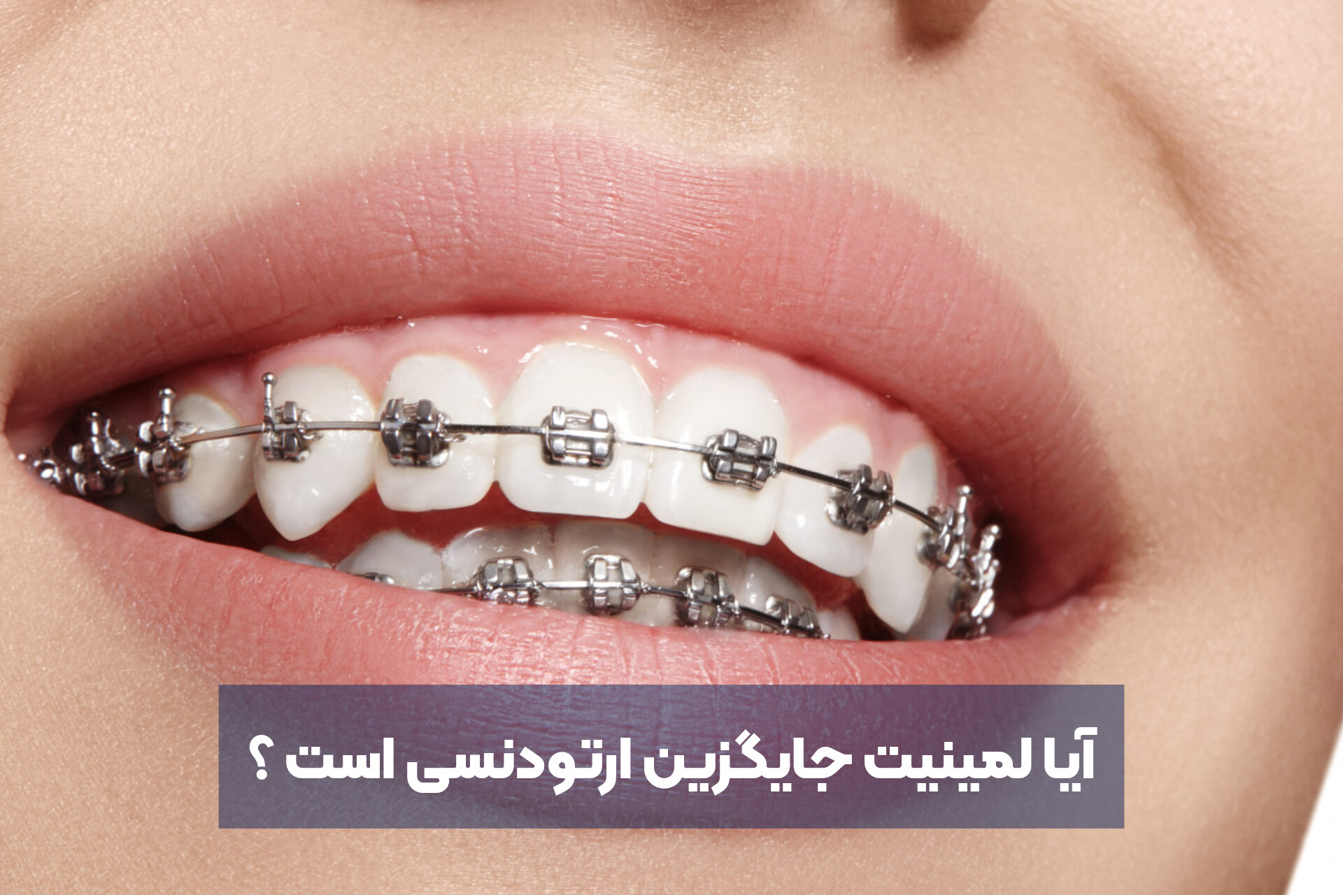 آیا لمینیت جایگزین ارتودنسی است ؟