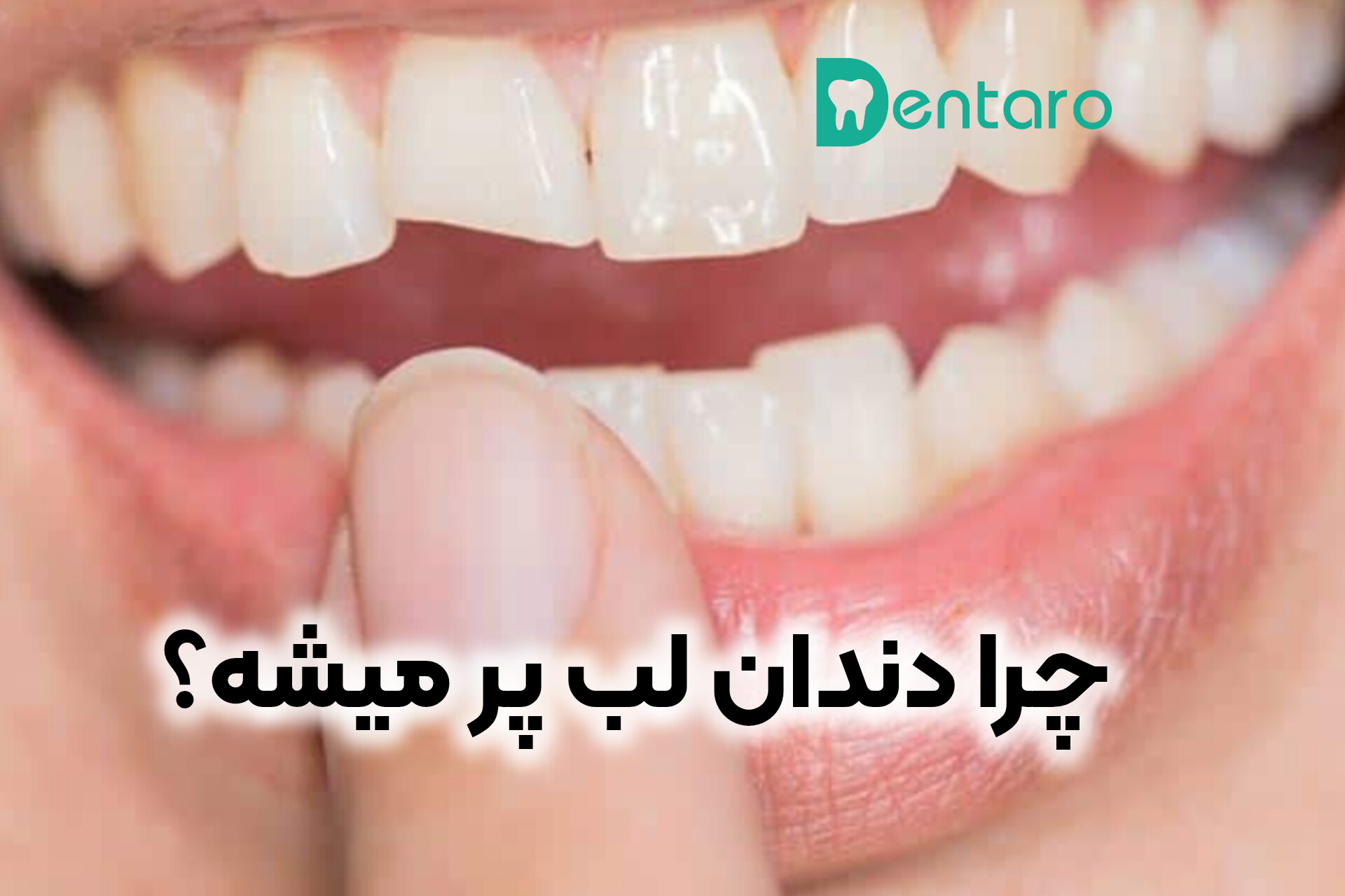 دنتارو چرا دندان لب پر می‌شود؟