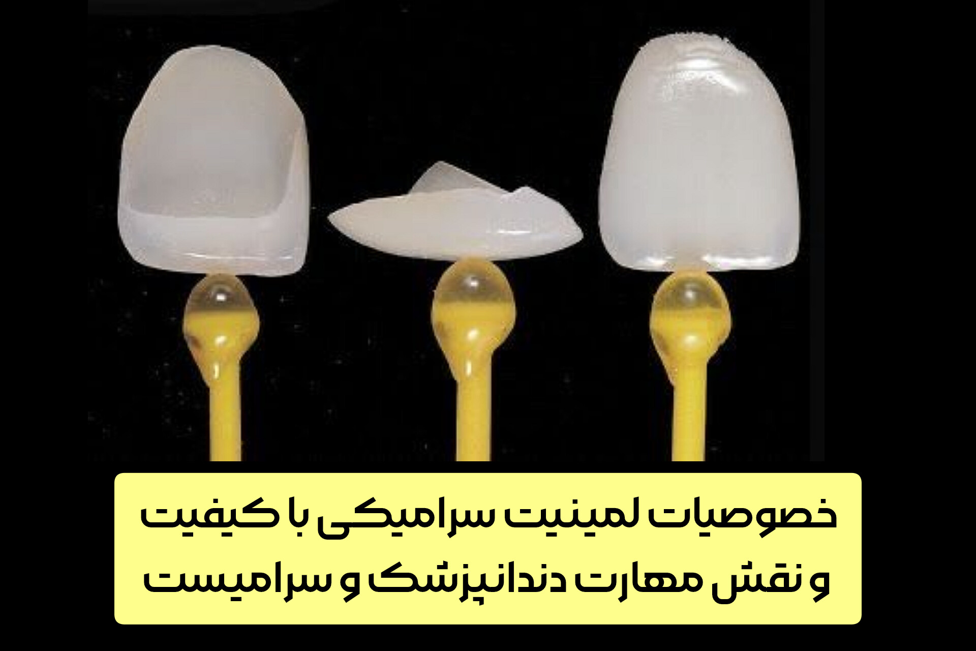 خصوصیات لمینیت سرامیکی با کیفیت و نقش مهارت دندانپزشک و سرامیست