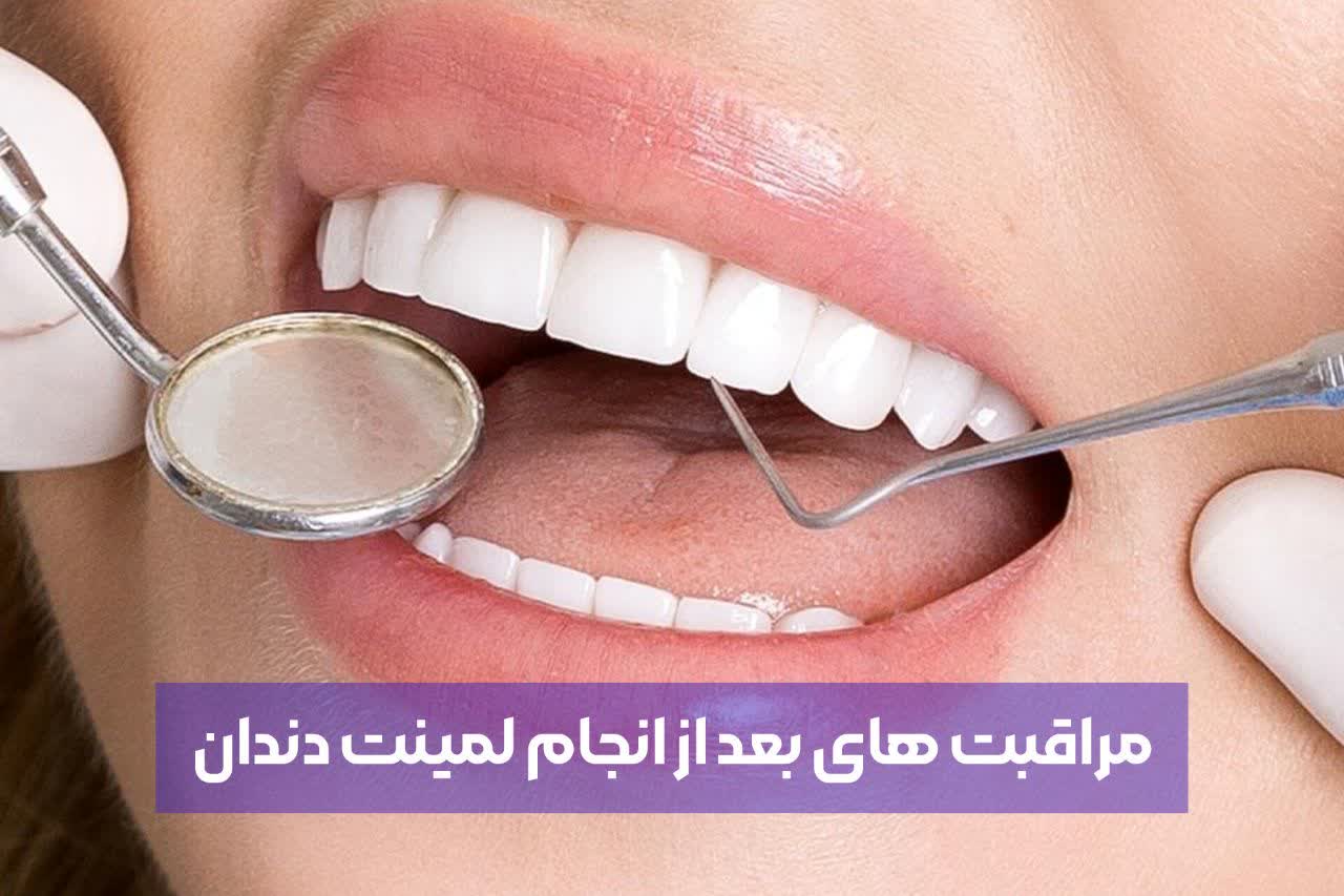 مراقبت های بعد از انجام لمینیت دندان