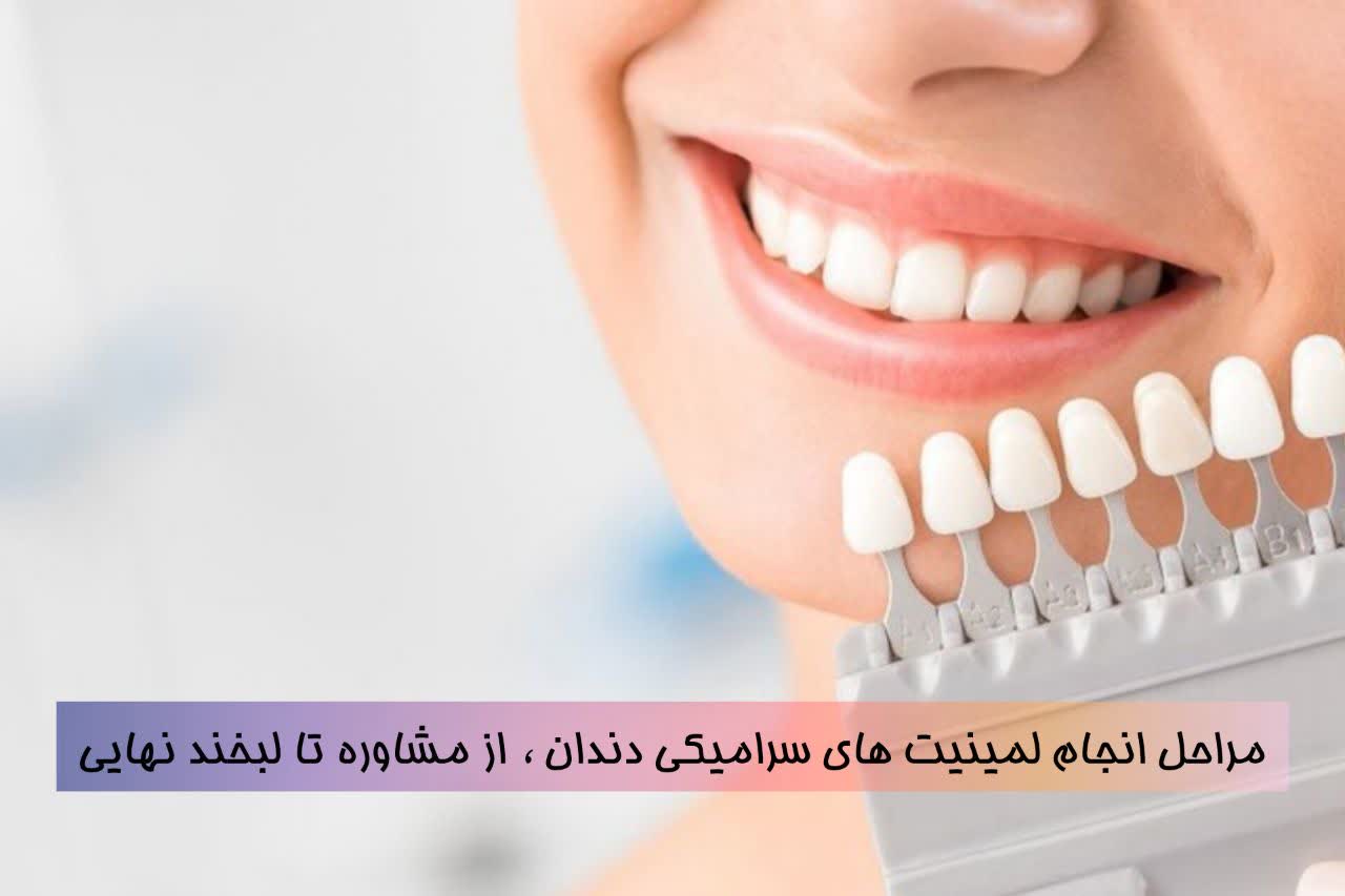 دنتارو مراحل انجام لمینت های سرامیکی دندان ، از مشاوره تا لبخند نهایی