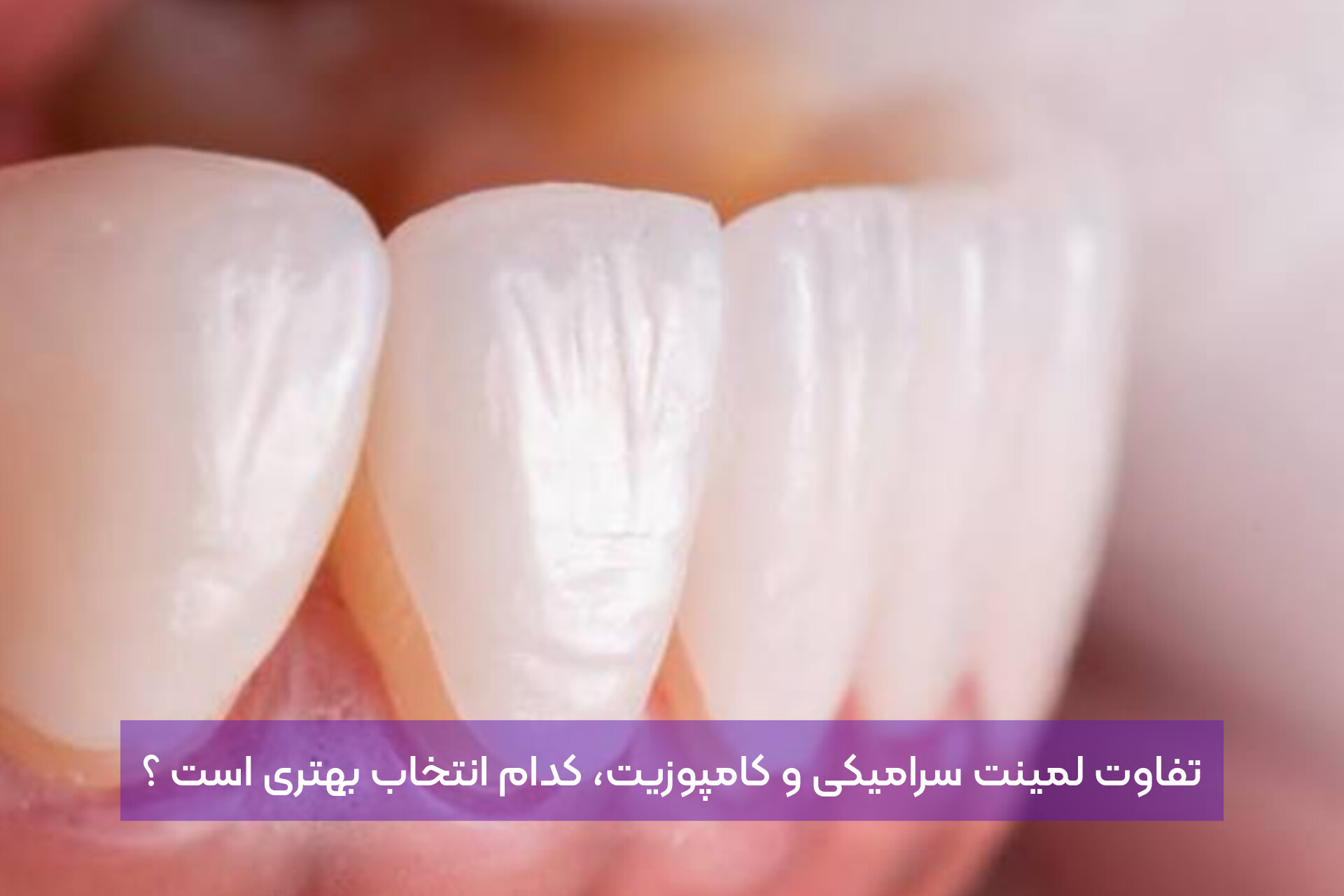تفاوت لمینت سرامیکی و کامپوزیت ، کدام انتخاب بهتری است ؟