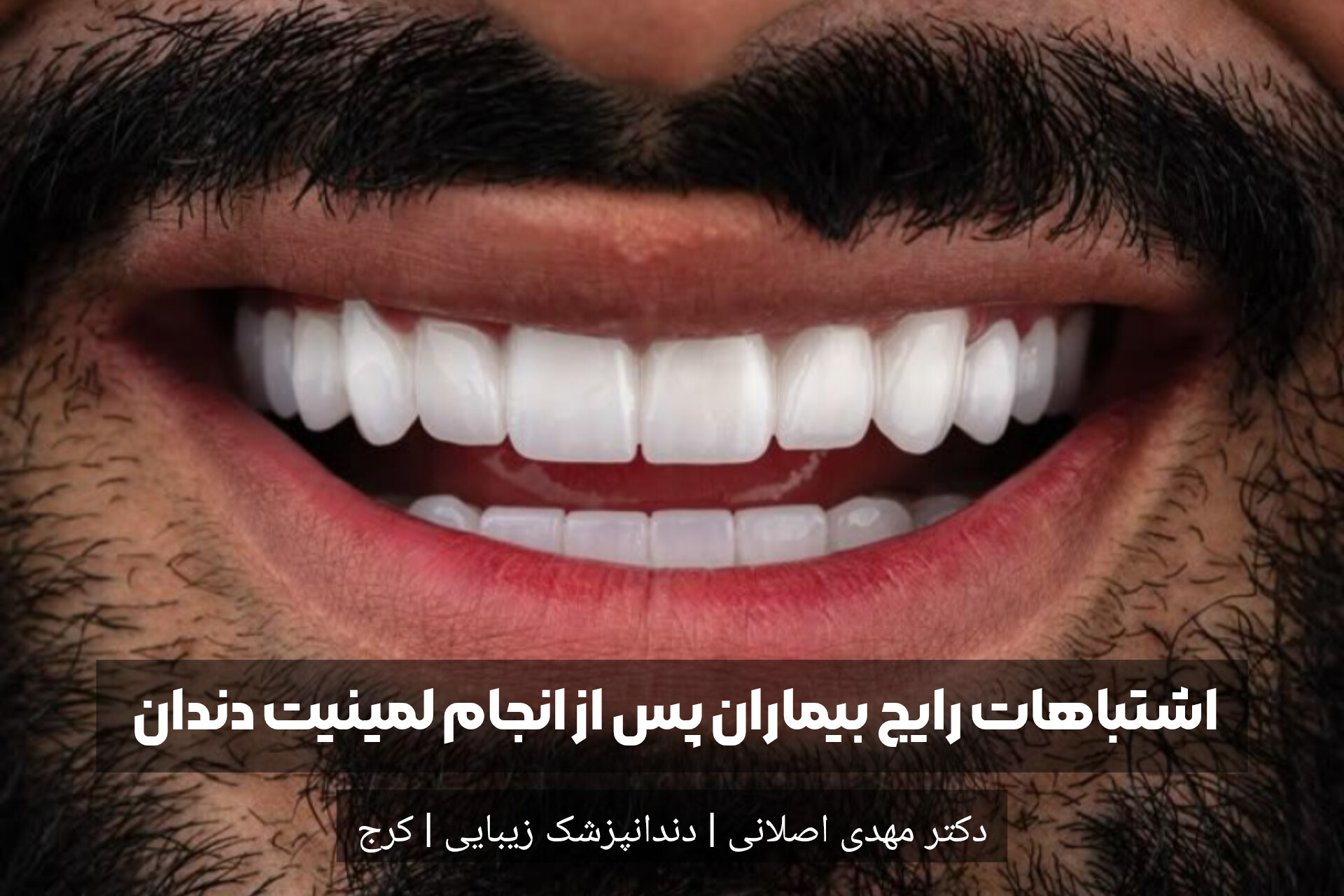 اشتباهات رایج بیماران پس از انجام لمینیت دندان