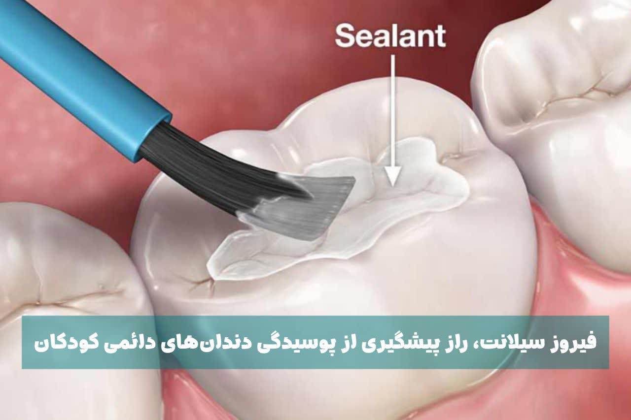 فیشور سیلانت ، راز پیشگیری از پوسیدگی دندان‌های دائمی کودکان
