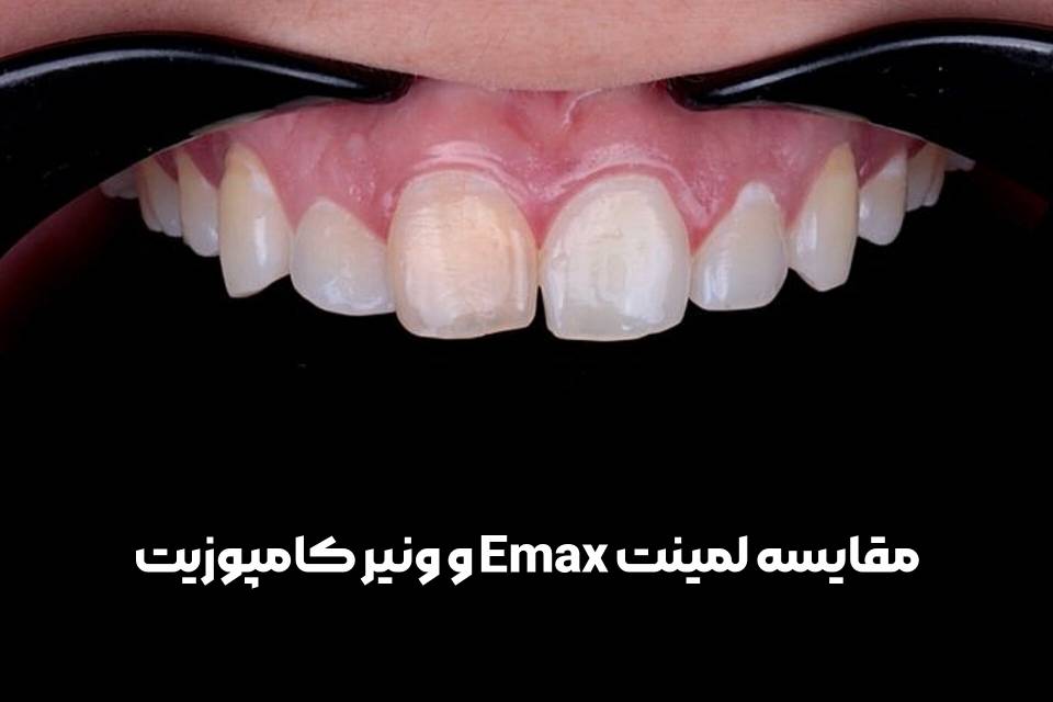دنتارو مقایسه لمینت Emax و ونیر کامپوزیت