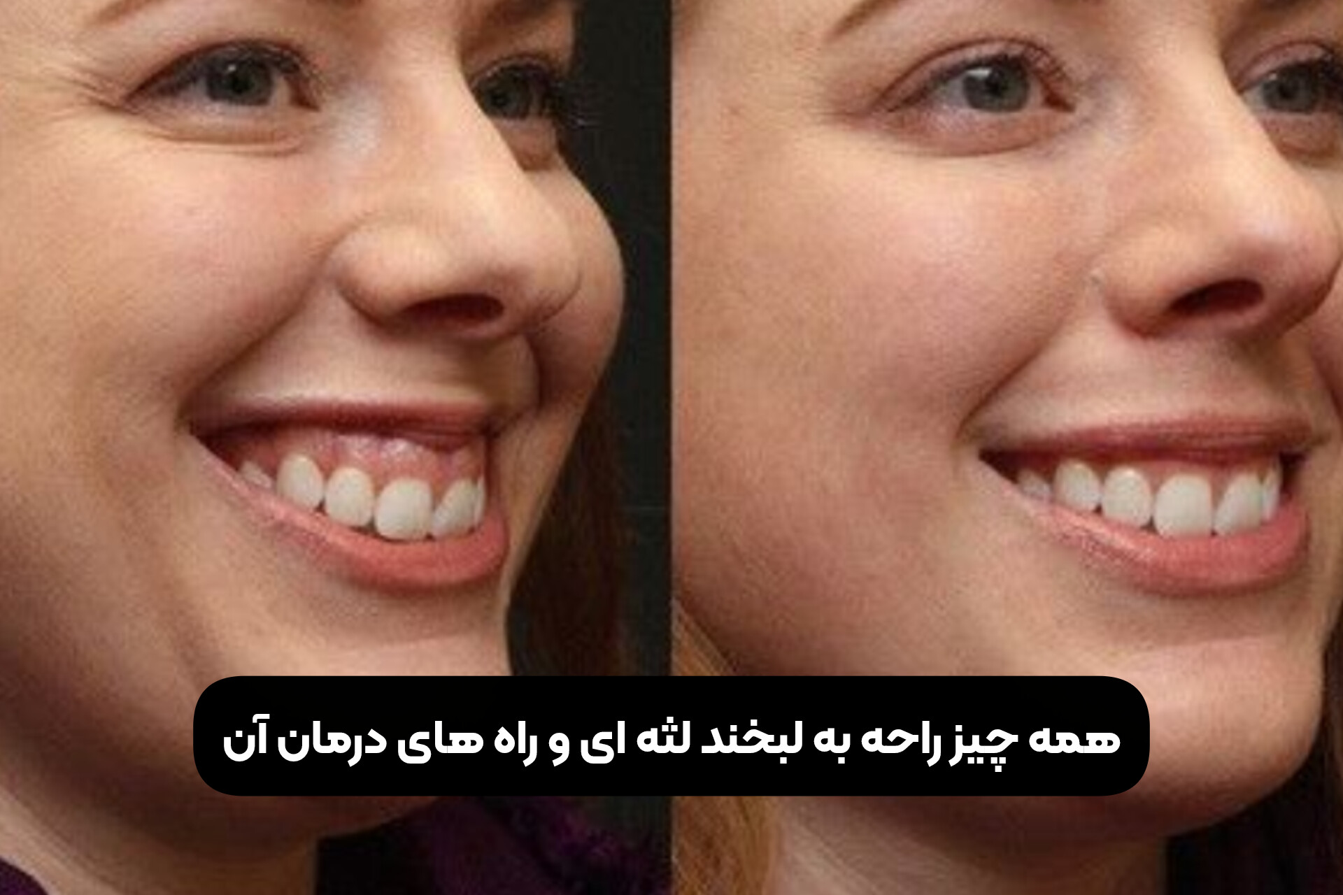 همه چیز راجع به لبخند لثه ای و راه های درمان آن