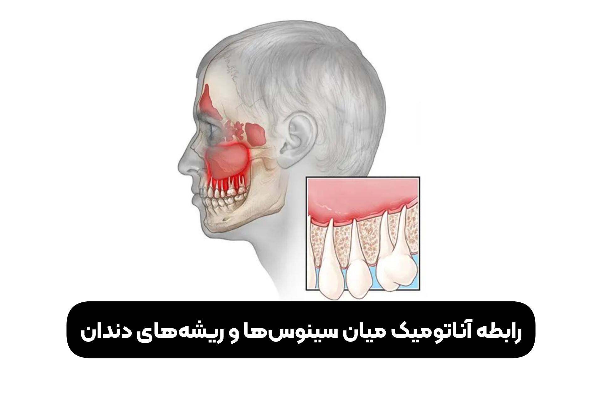 رابطه آناتومیک میان سینوس‌ها و ریشه‌های دندان