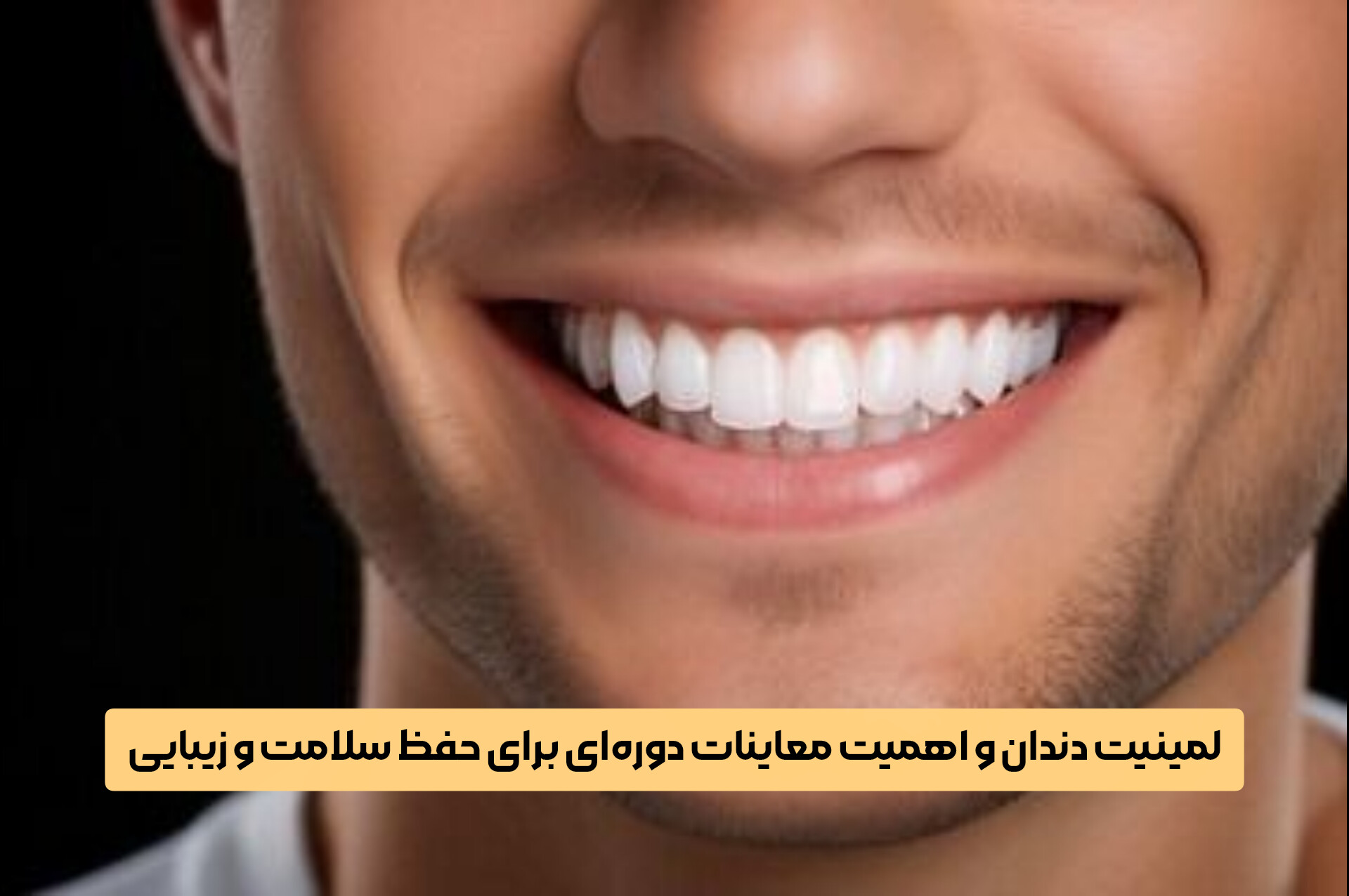 لمینیت دندان و اهمیت معاینات دوره‌ای برای حفظ سلامت و زیبایی