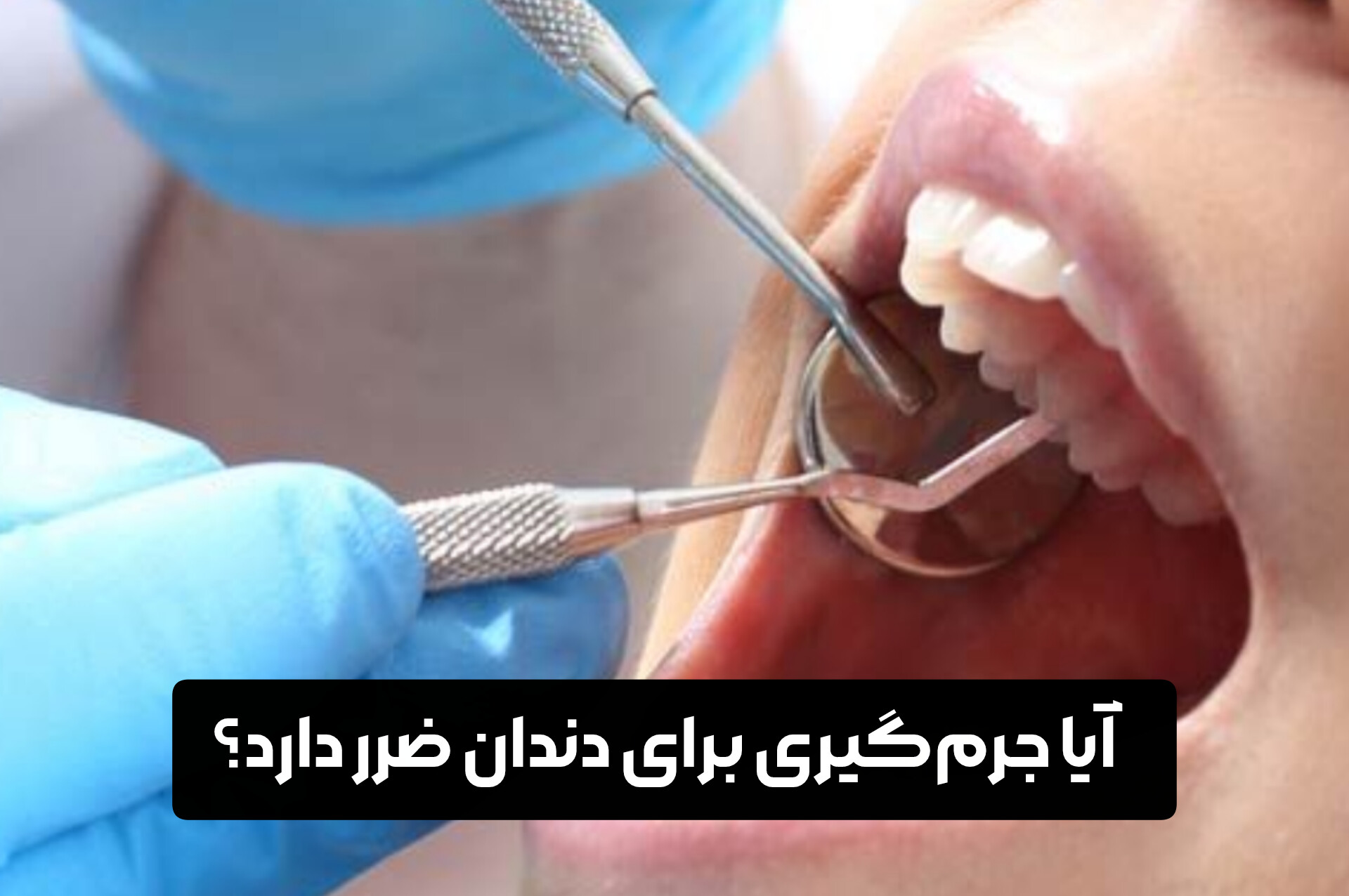 آیا جرم‌گیری برای دندان ضرر دارد؟