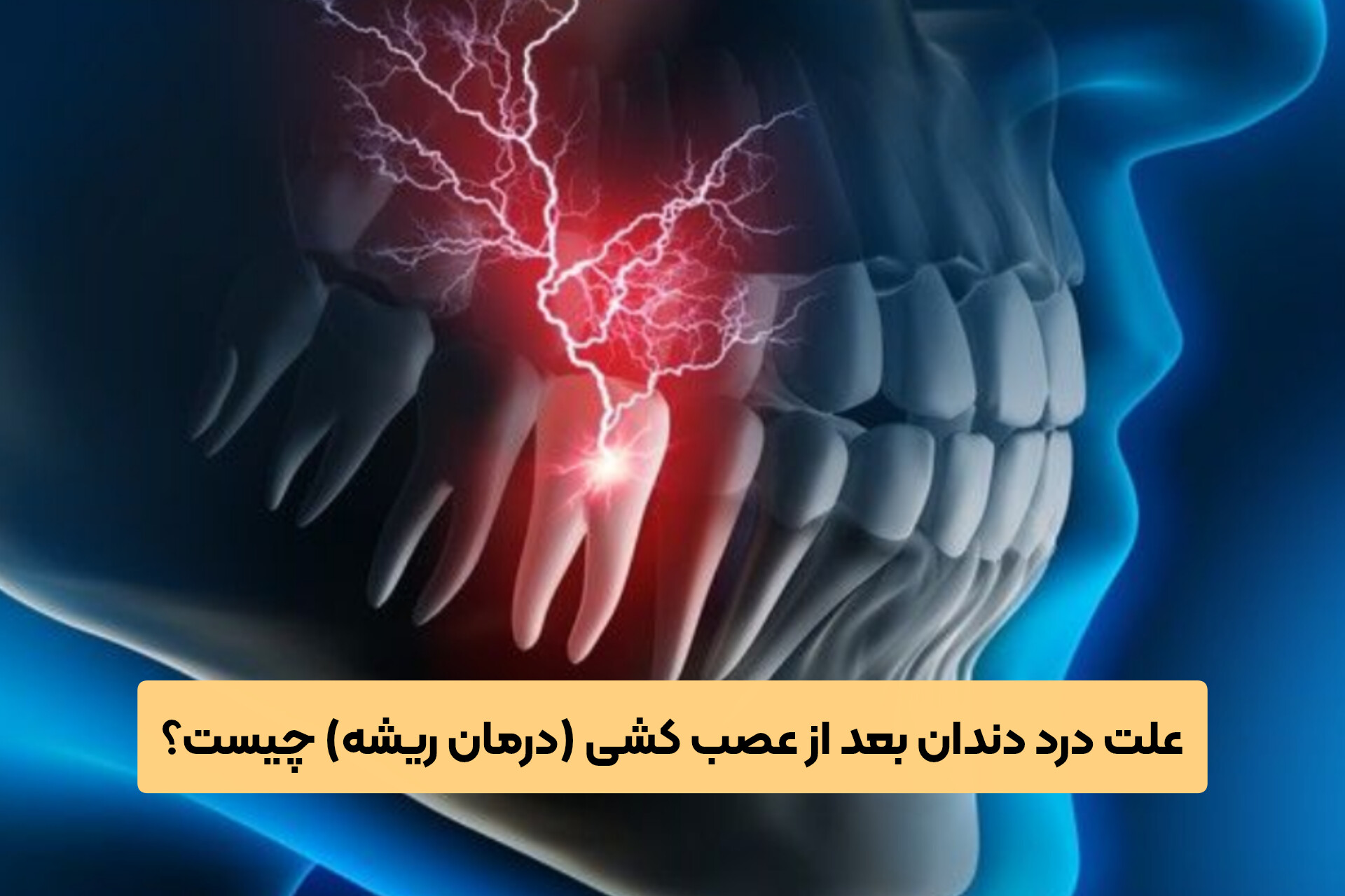 علت درد دندان بعد از عصب کشی (درمان ریشه) چیست؟
