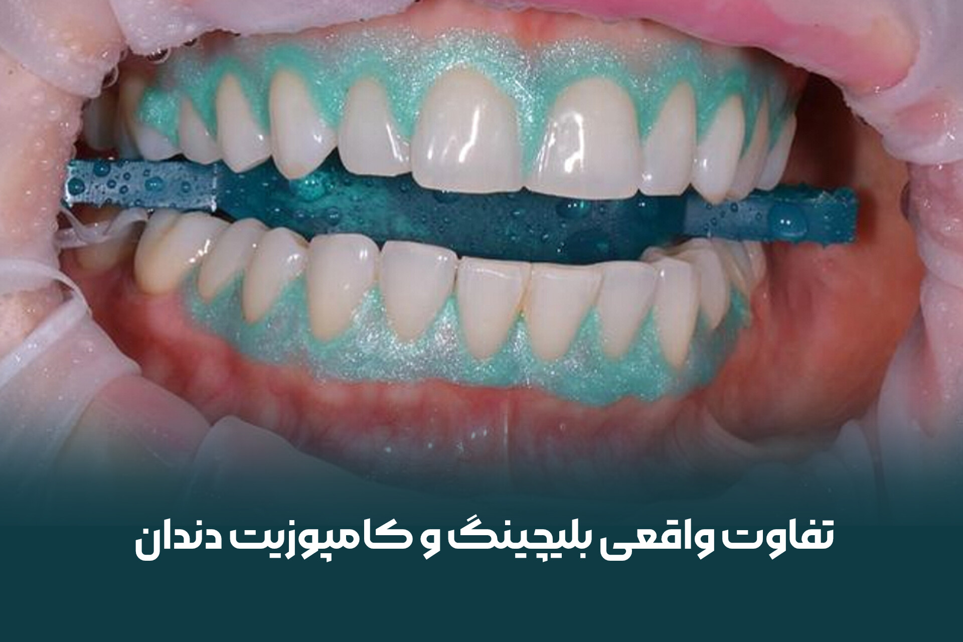 تفاوت واقعی بلیچینگ و کامپوزیت دندان