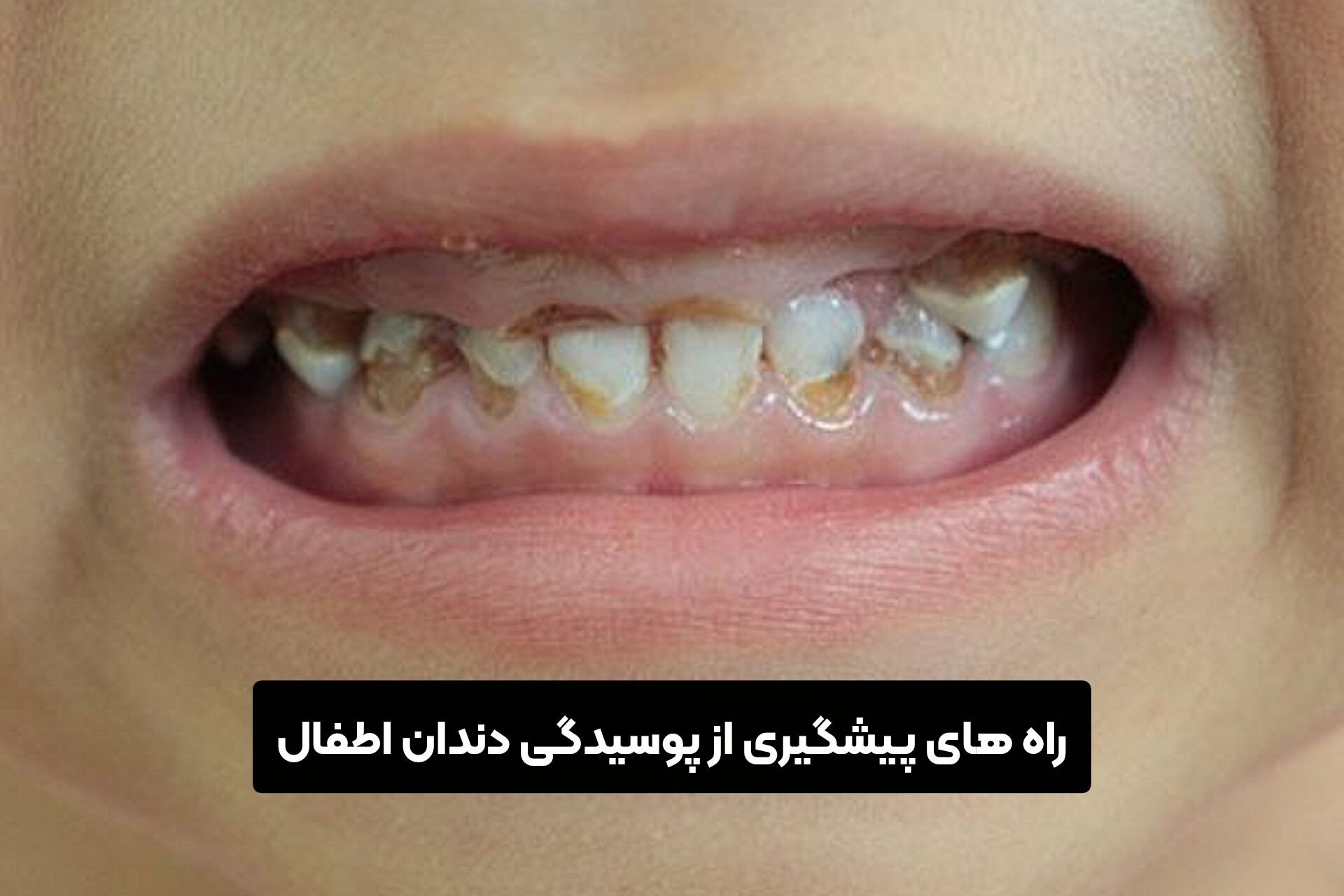 راه های پیشگیری از پوسیدگی دندان اطفال