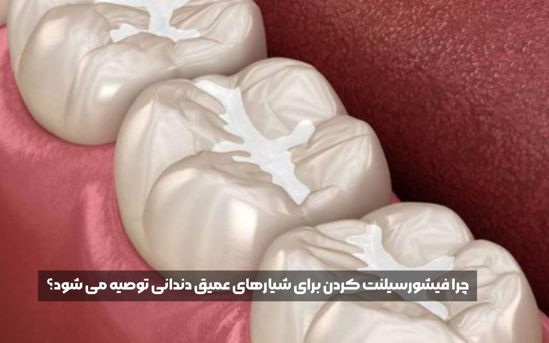 چرا فیشورسیلنت کردن برای شیارهای عمیق دندانی توصیه می شود؟