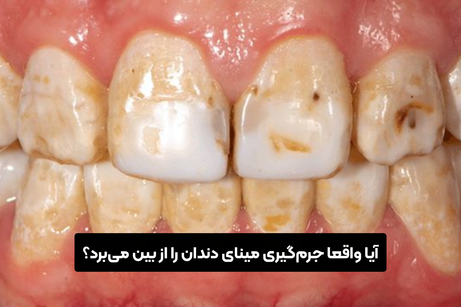آیا واقعا جرم‌گیری مینای دندان را از بین می‌برد؟