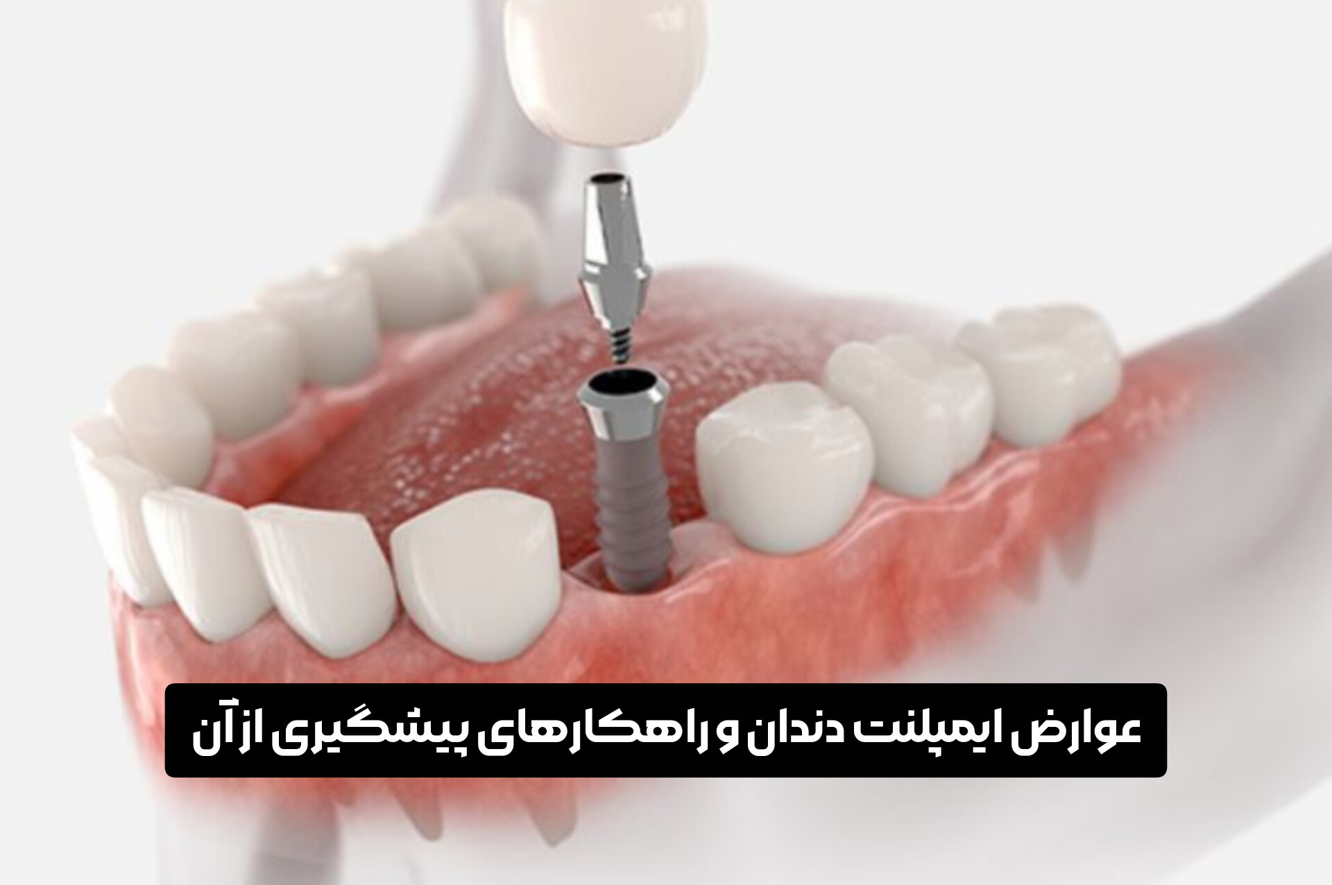 عوارض ایمپلنت دندان و راهکارهای پیشگیری از آن