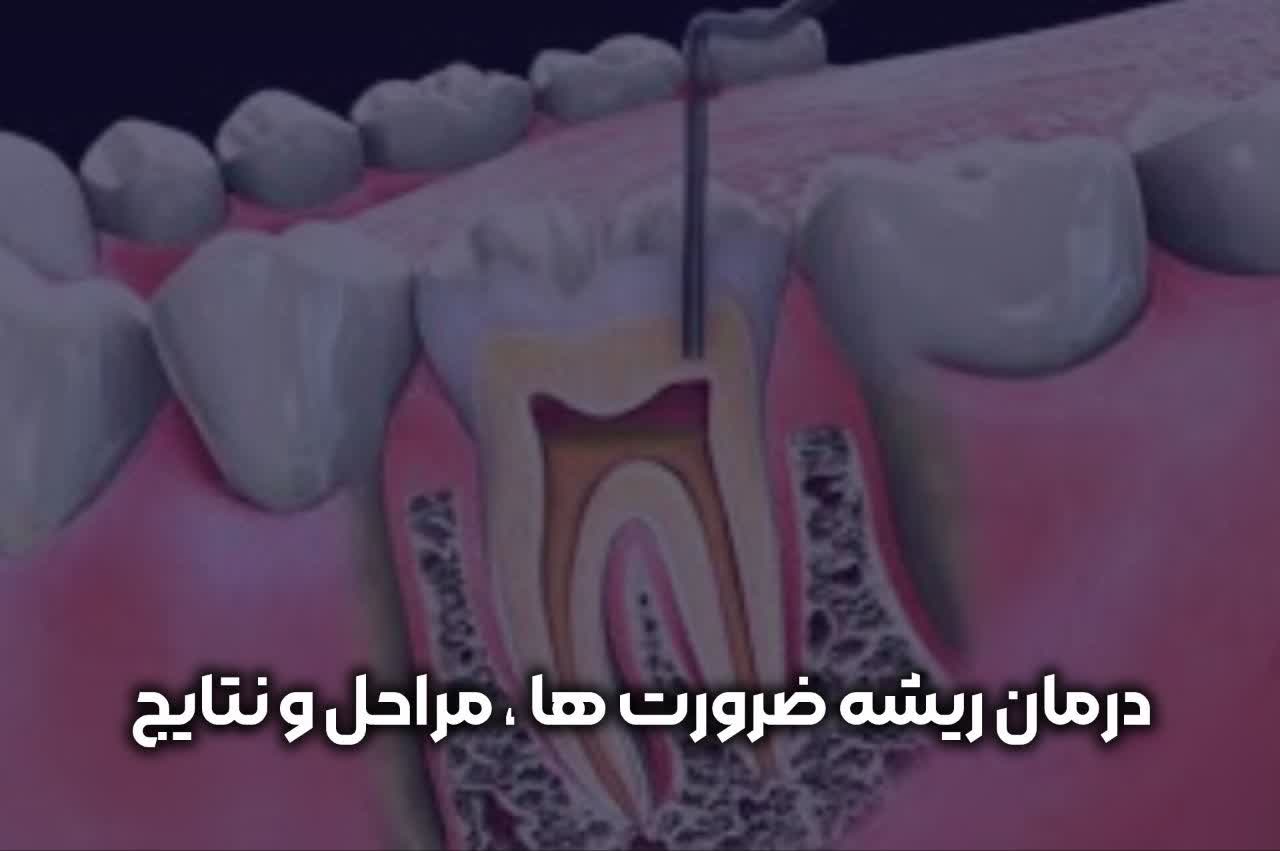 درمان ریشه ضرورت ها مراحل ونتایج