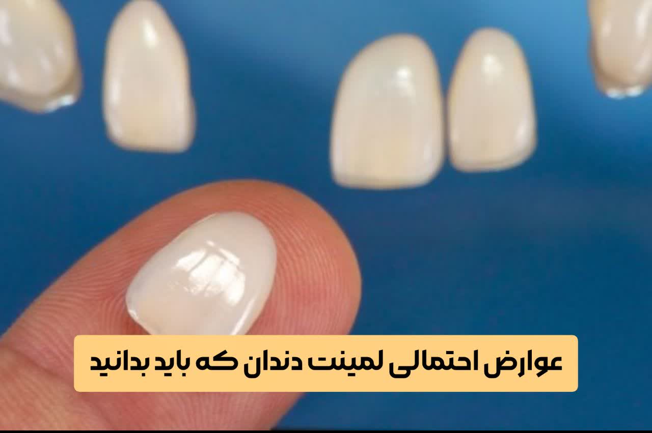 عوارض احتمالی لمینت دندان که باید بدانید