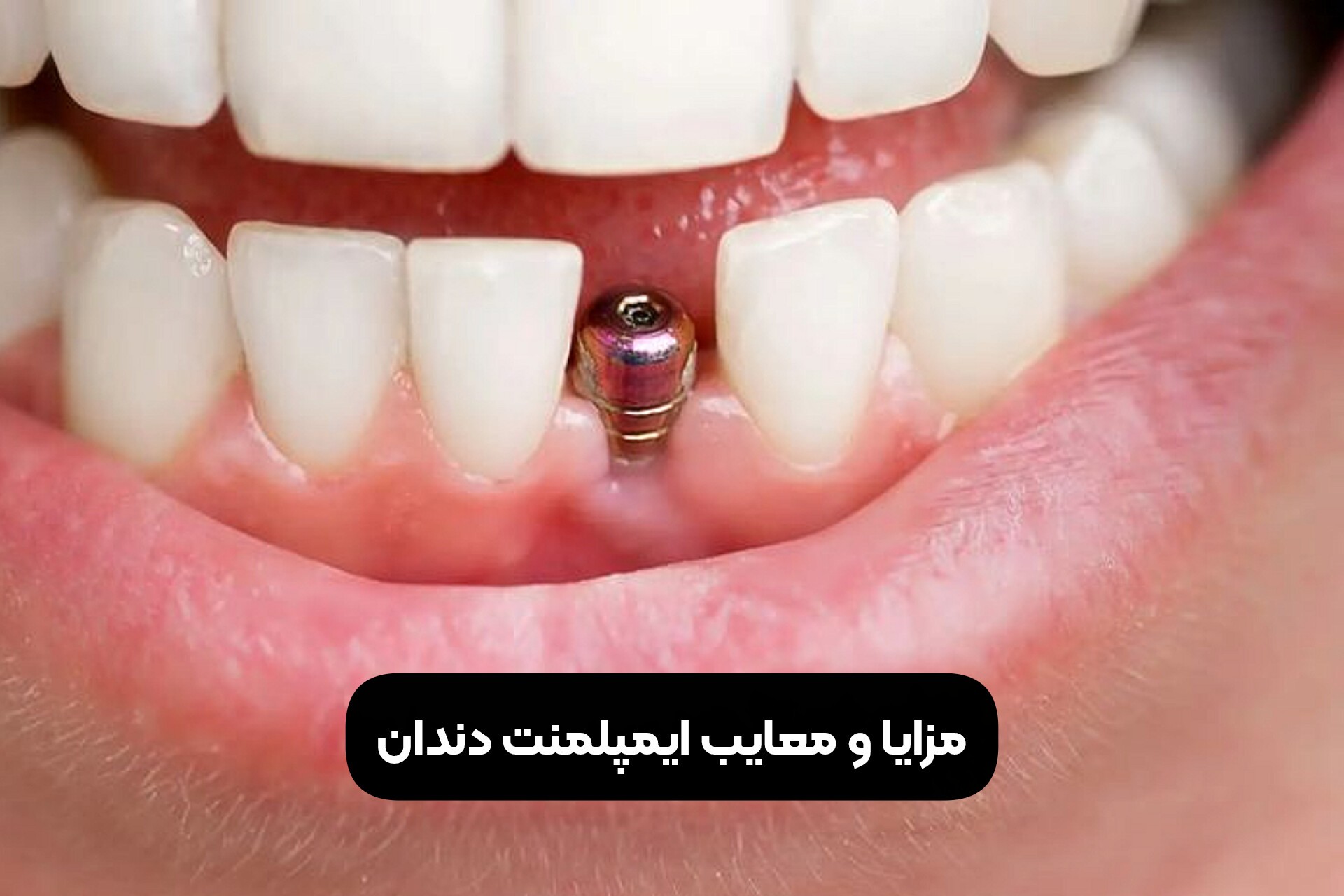 مزایا و معایب ایمپلمنت دندان