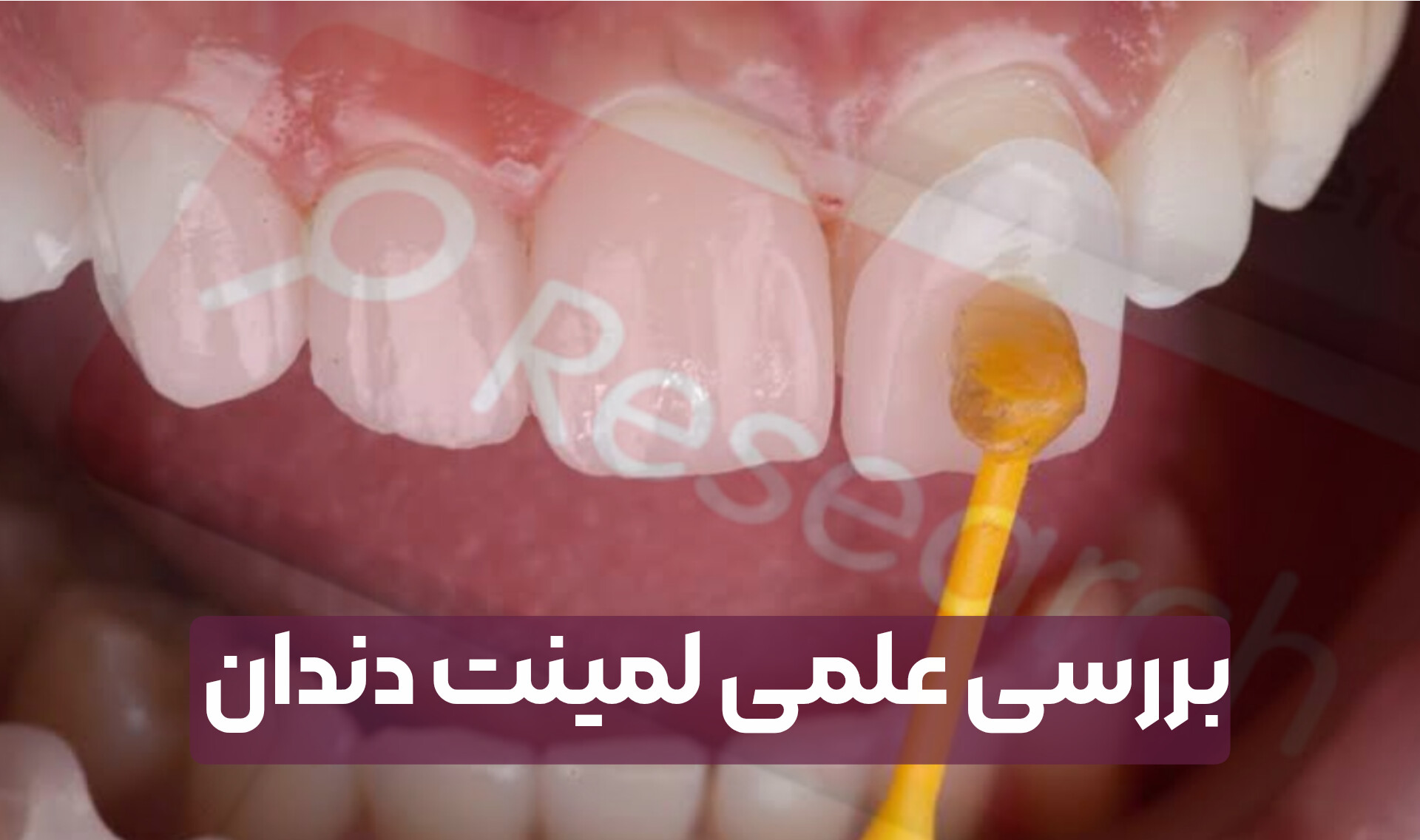 بررسی علمی ماندگاری لمینت