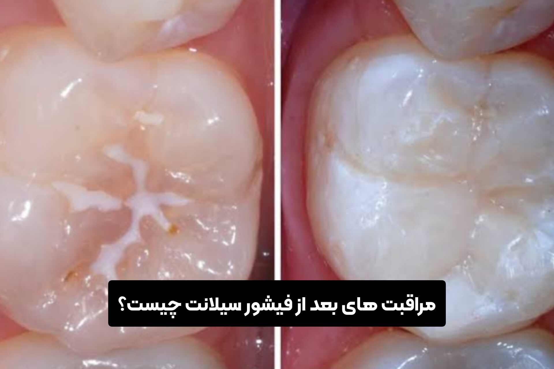 مراقبت های بعد از فیشور سیلانت چیست؟