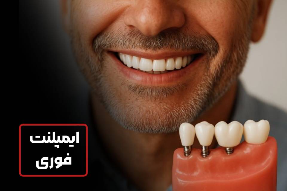 دنتارو ایمپلنت فوری