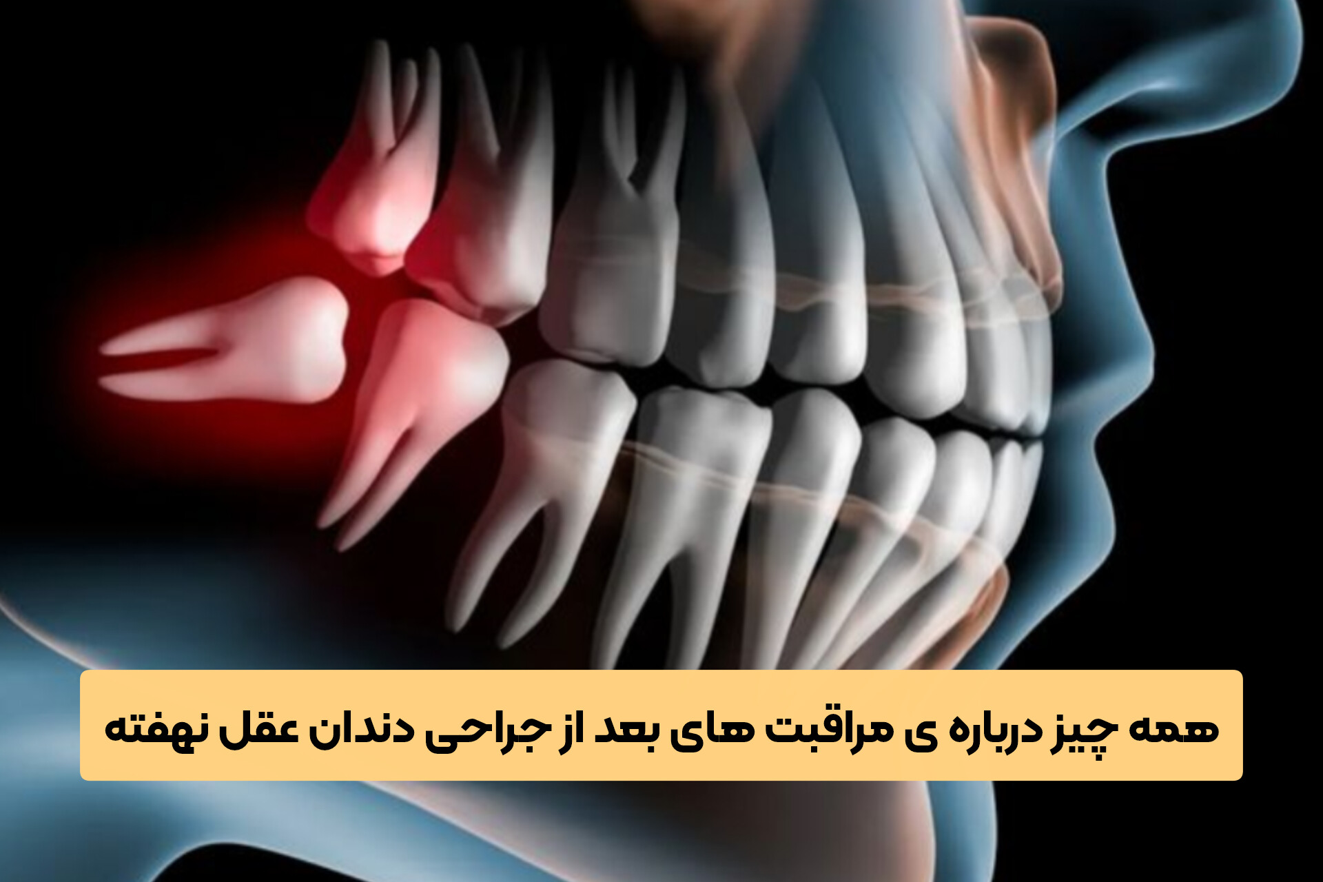 همه چیز درباره ی مراقبت های بعد از جراحی دندان عقل نهفته