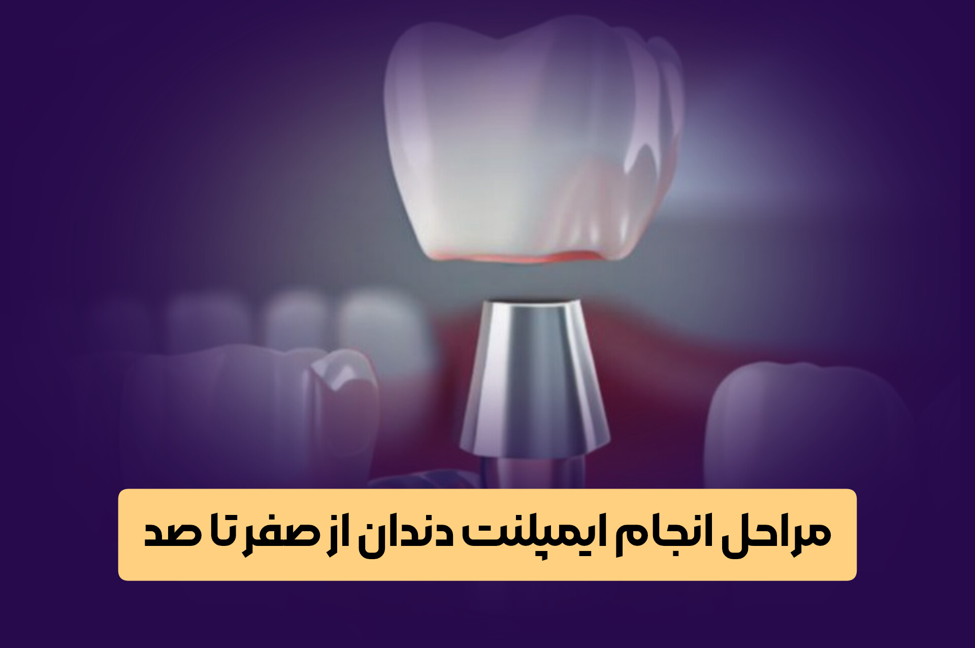 مراحل انجام ایمپلنت دندان از صفر تا صد