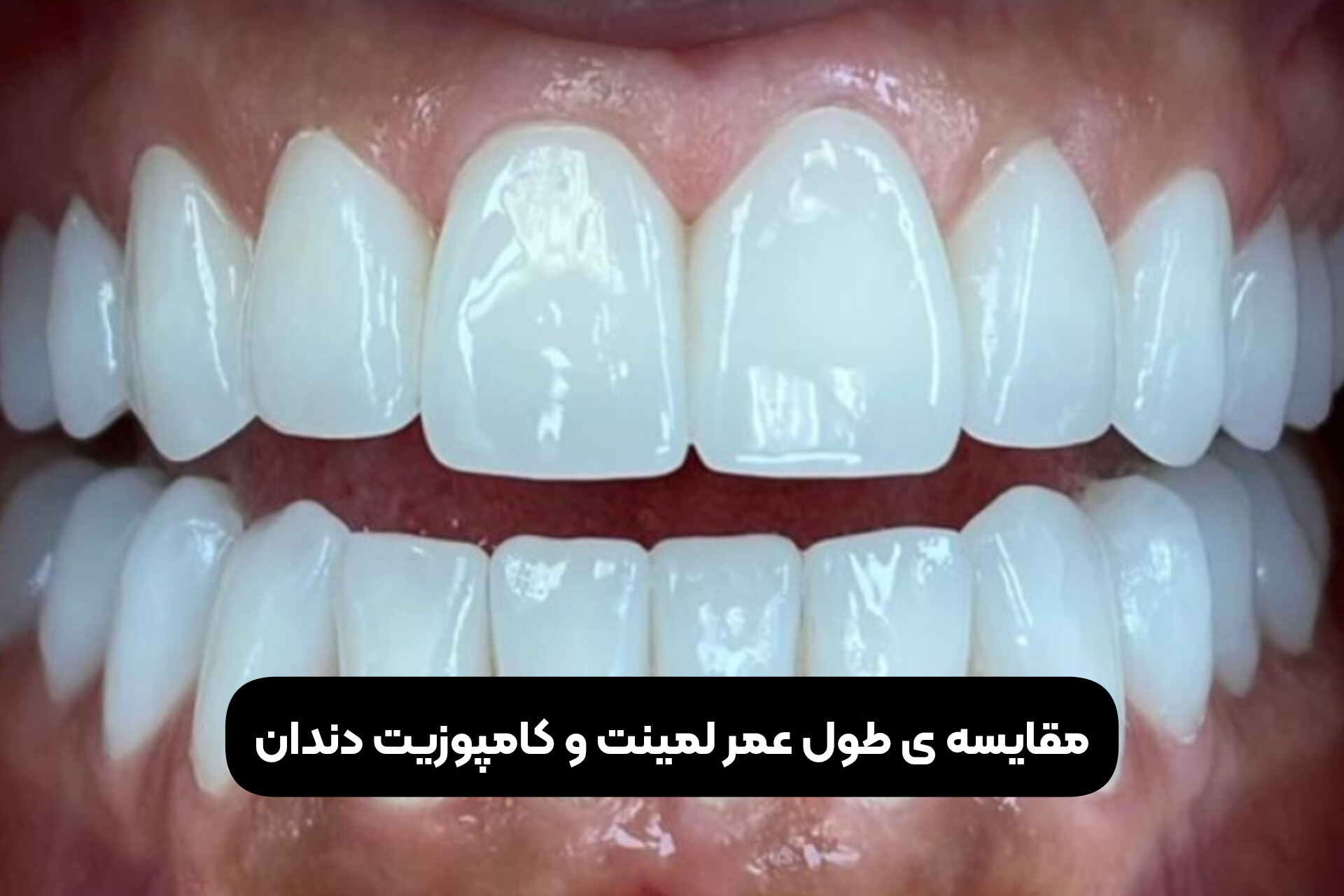 مقایسه ی طول عمر لمینت و کامپوزیت دندان