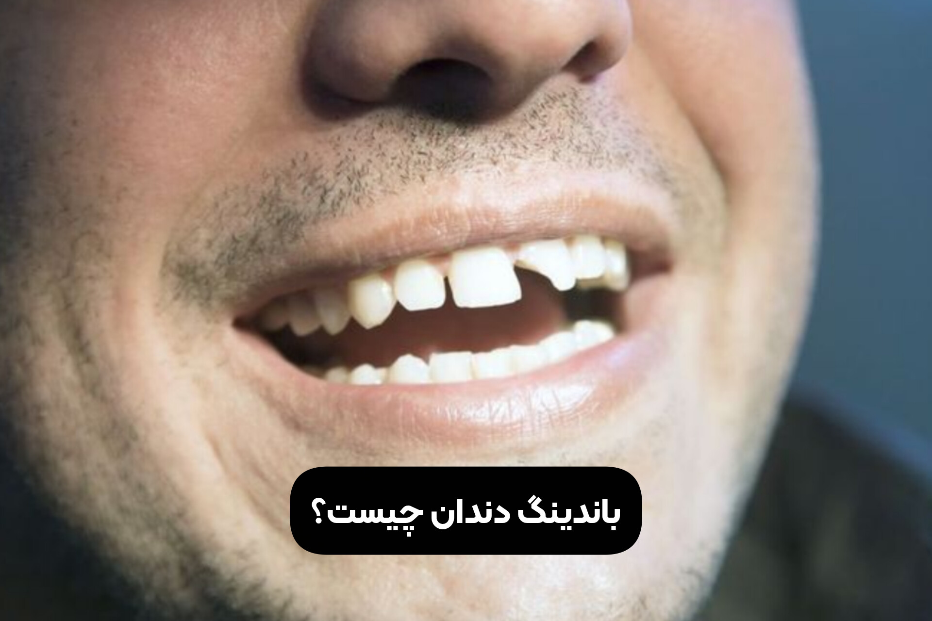 باندینگ دندان چیست؟