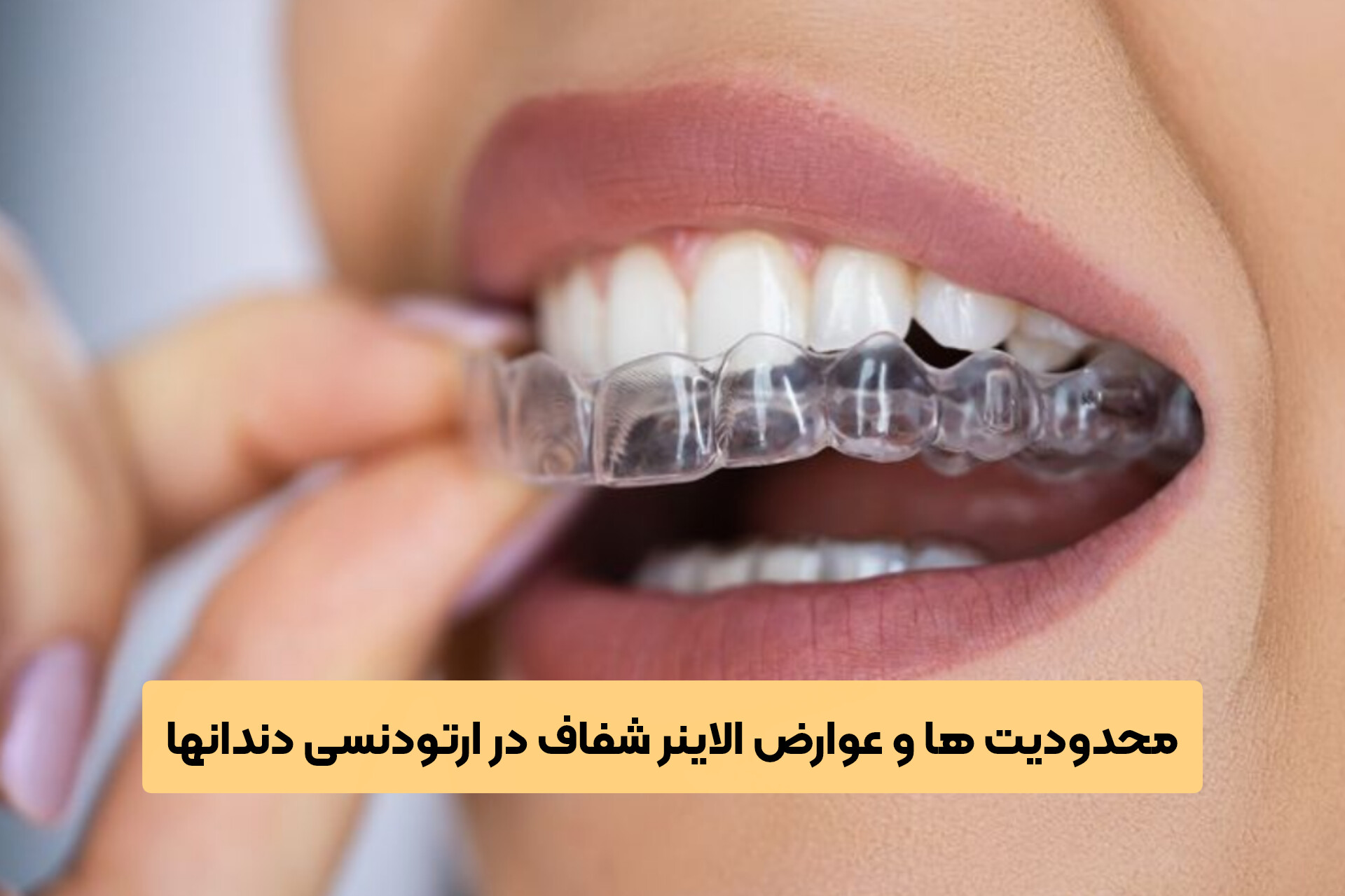 محدودیت ها و عوارض الاینر شفاف در ارتودنسی دندانها