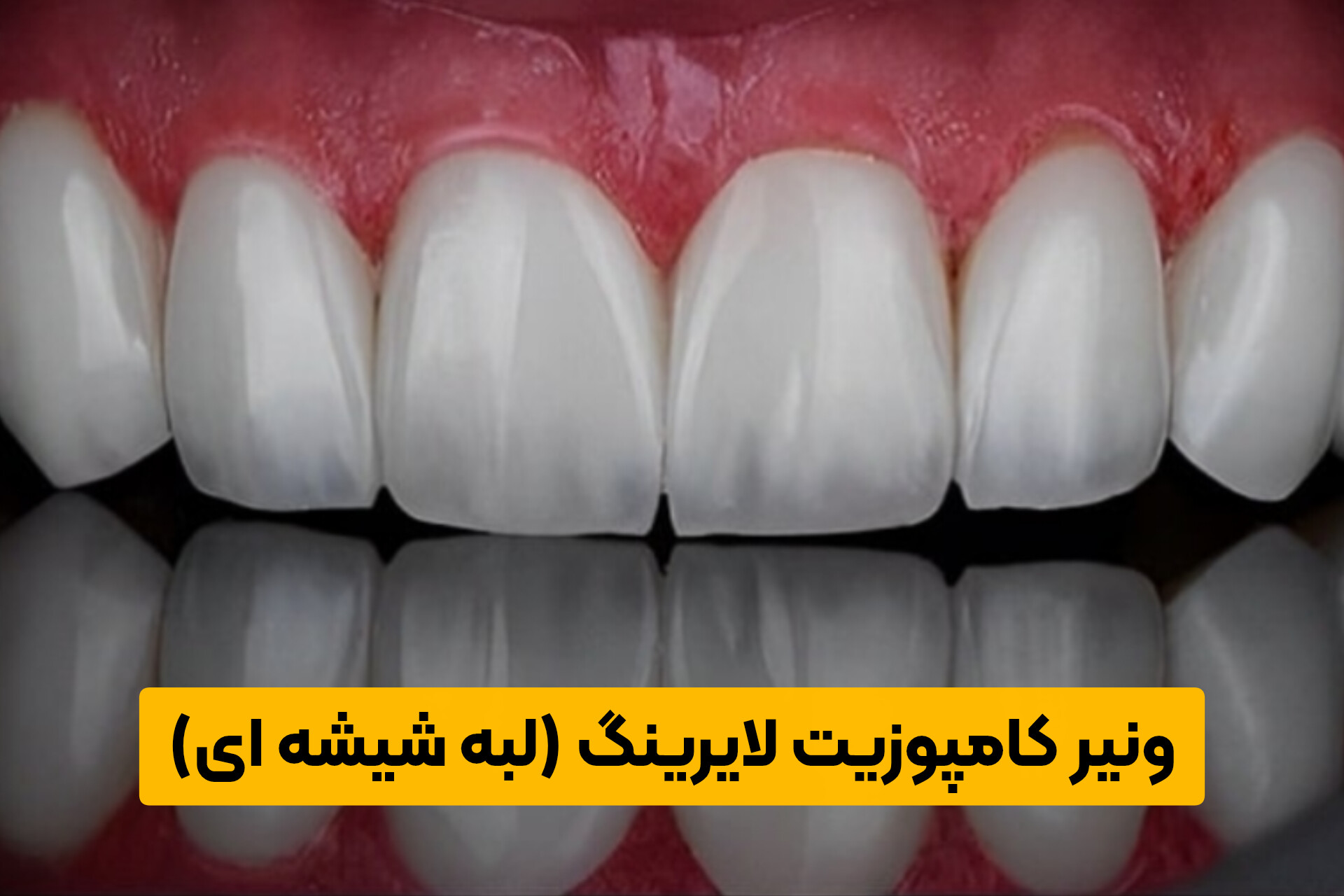 ونیر کامپوزیت لایرینگ (لبه شیشه ای)