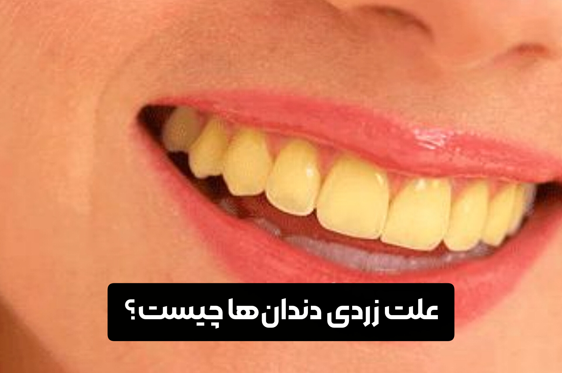 علت زردی ‌دندان‌ها چیست؟