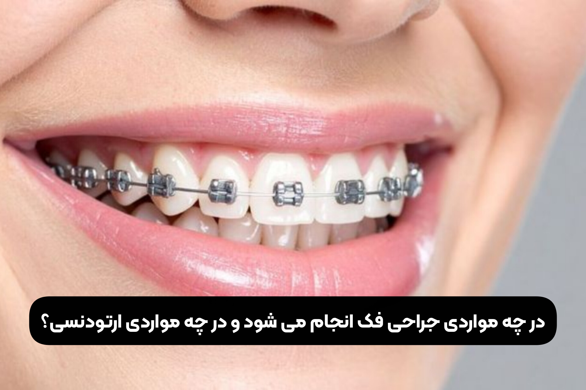 در چه مواردی جراحی فک انجام می شود و در چه مواردی ارتودنسی؟