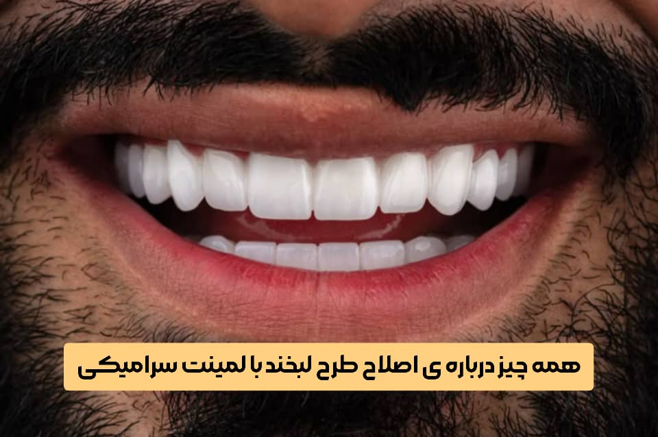 همه چیز درباره ی اصلاح طرح لبخند با لمینت سرامیکی